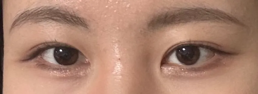 몰랐는데 저 눈재수술 효과 개쩌네여