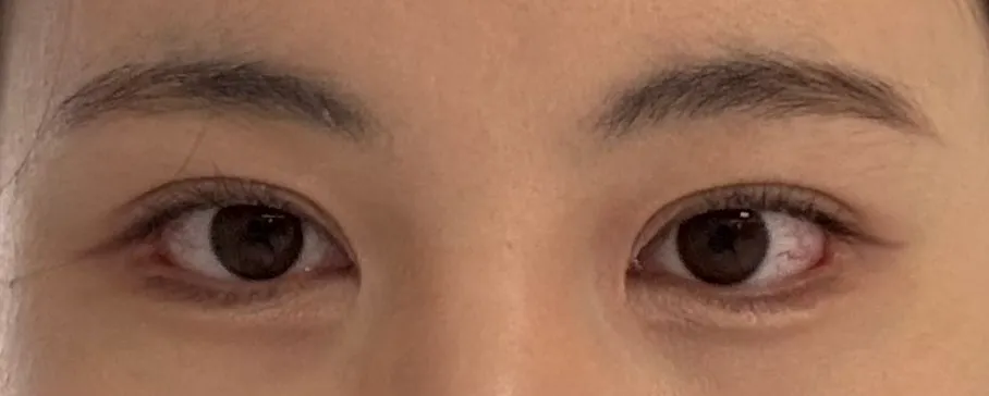몰랐는데 저 눈재수술 효과 개쩌네여2