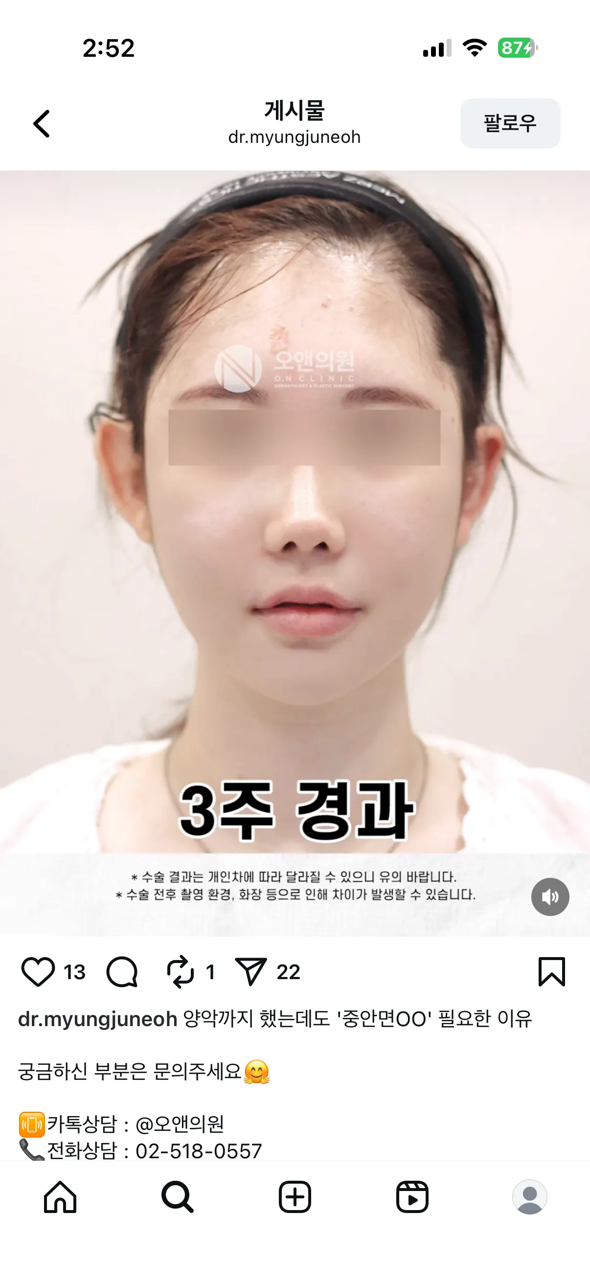양악하면 이런입매되는게 국룰인가요?