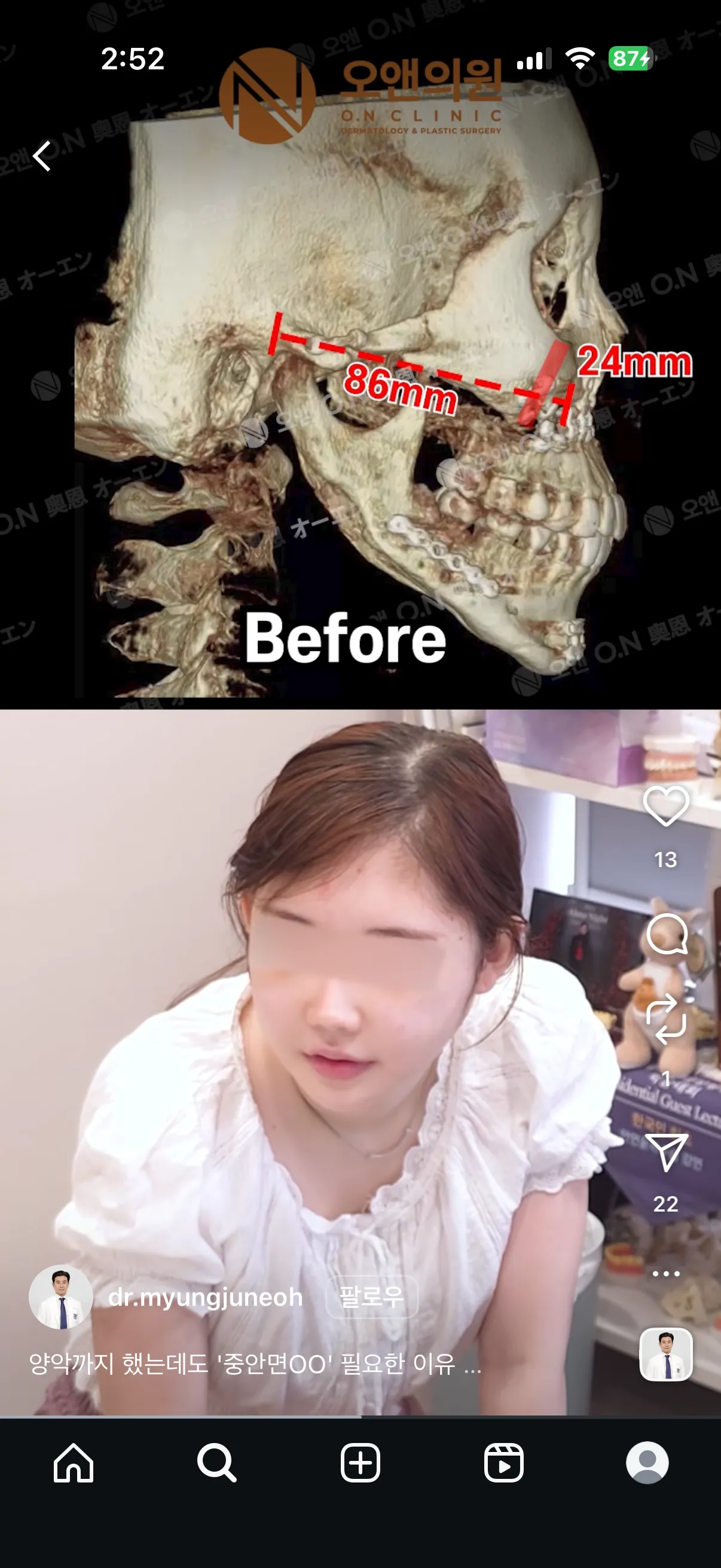 양악하면 이런입매되는게 국룰인가요?2